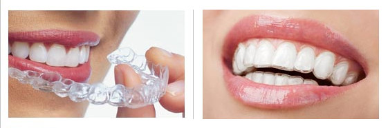 invisalign-clear-braces