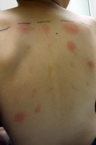 NathanAllergy1